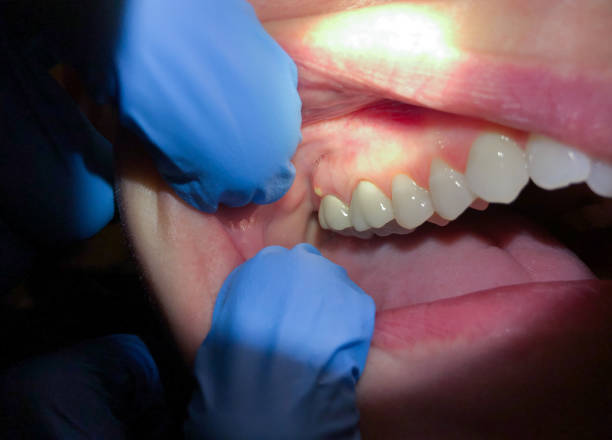 Best Emergency Tooth Extraction in Braddock, VA